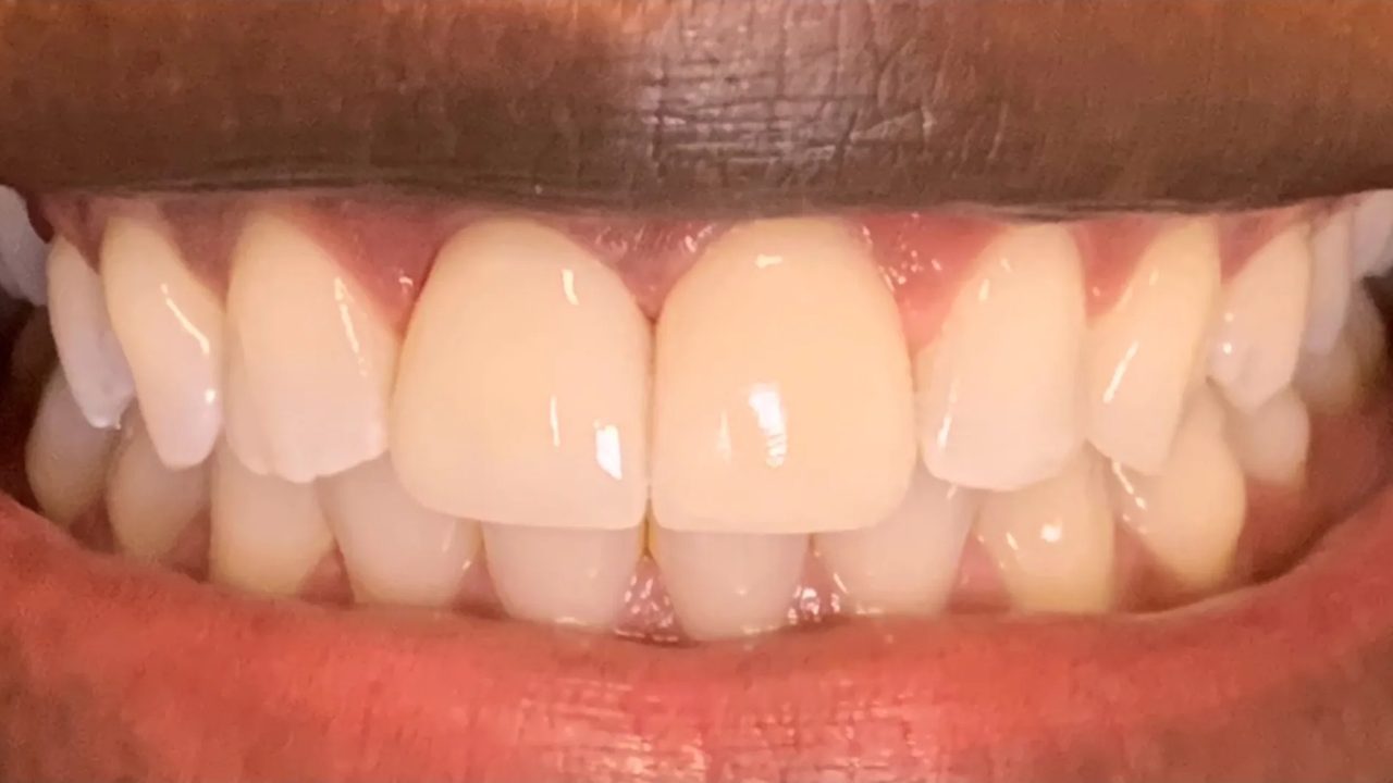 Smile case 2 after treatment at Rovel Dental