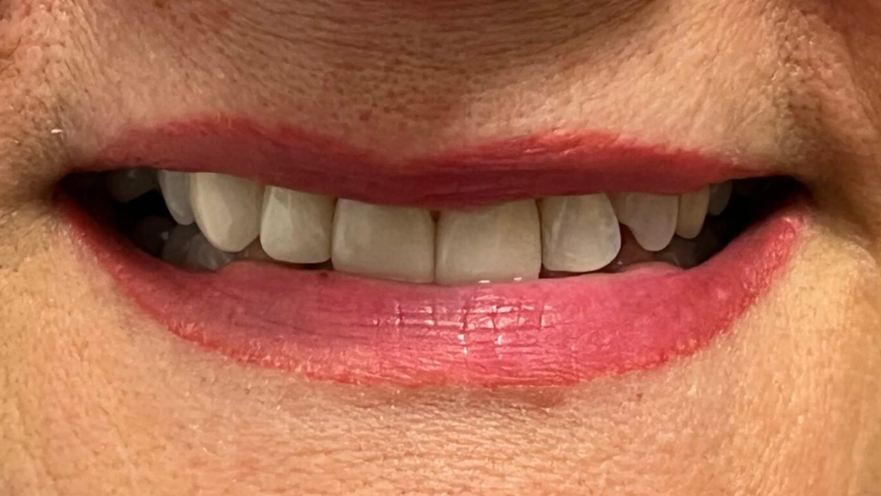 Patient smile after treatment at Rovel Dental