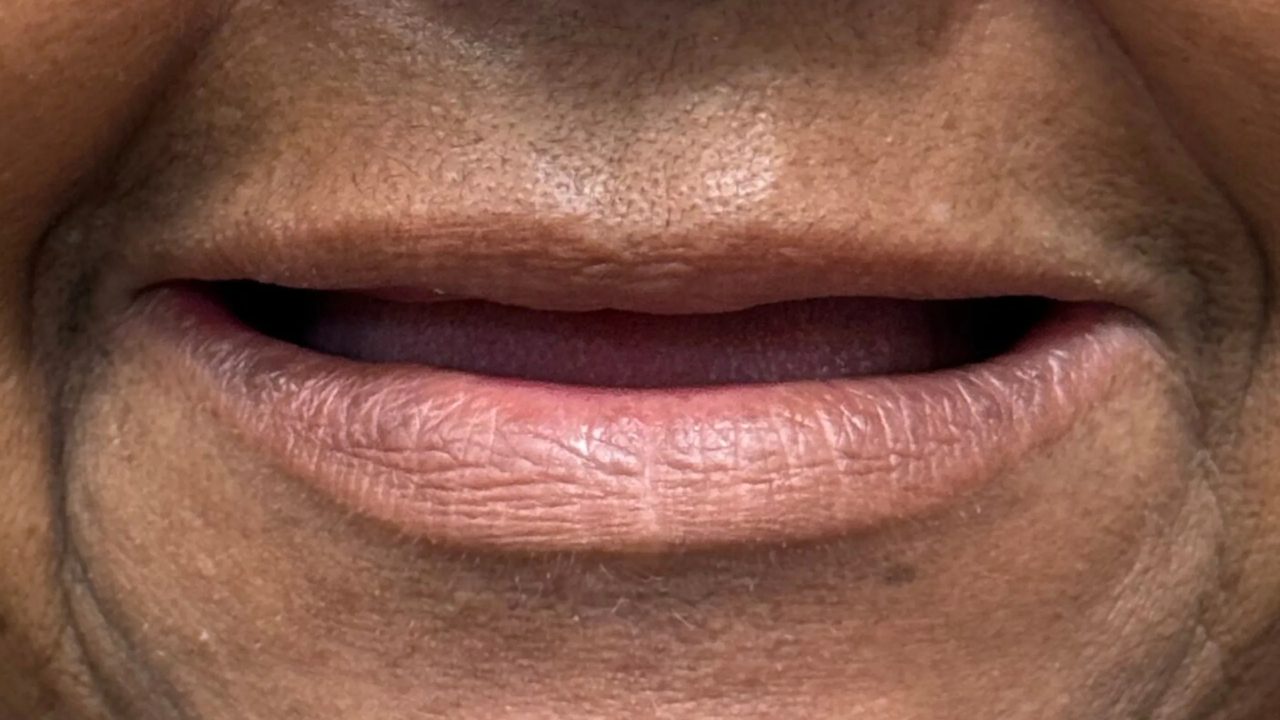 Smile case 7 before treatment