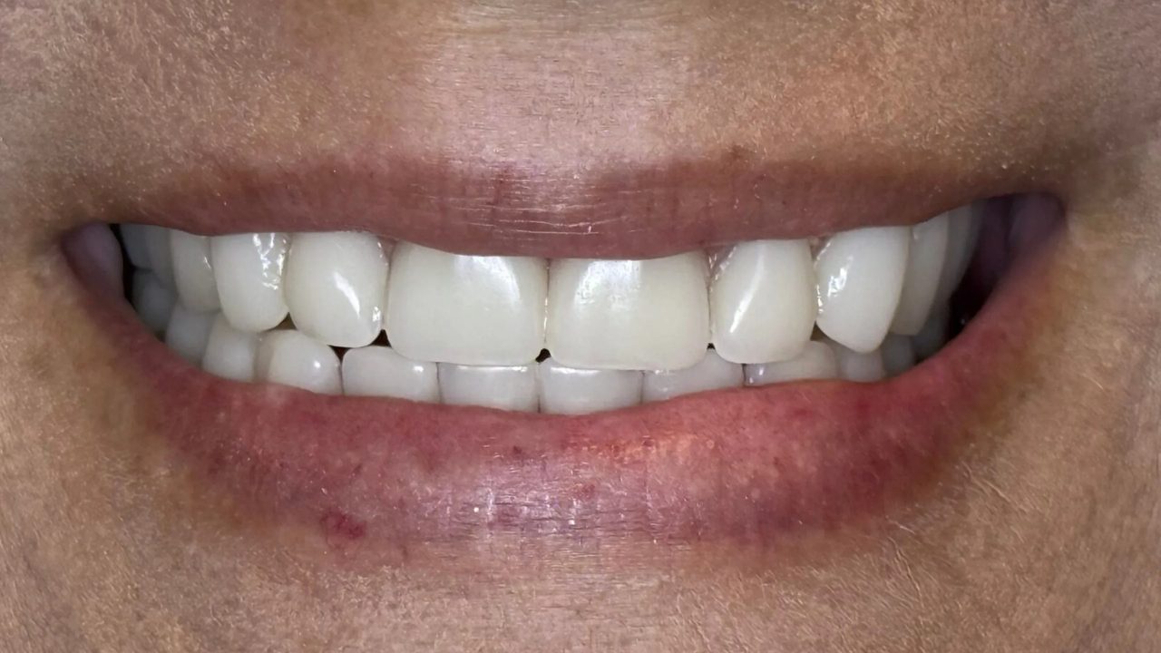 Smile case 8 before treatment