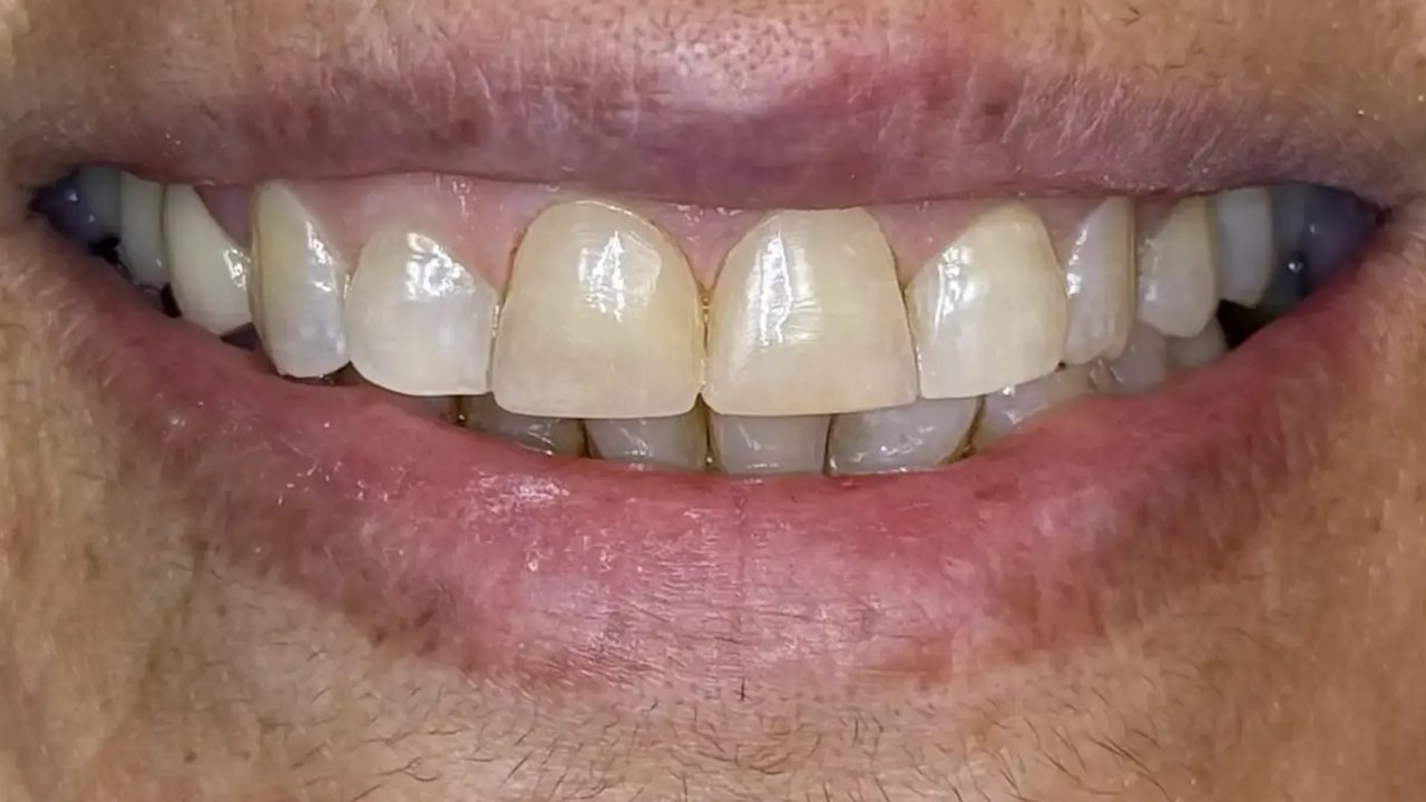 Smile case 13 after treatment at Rovel Dental