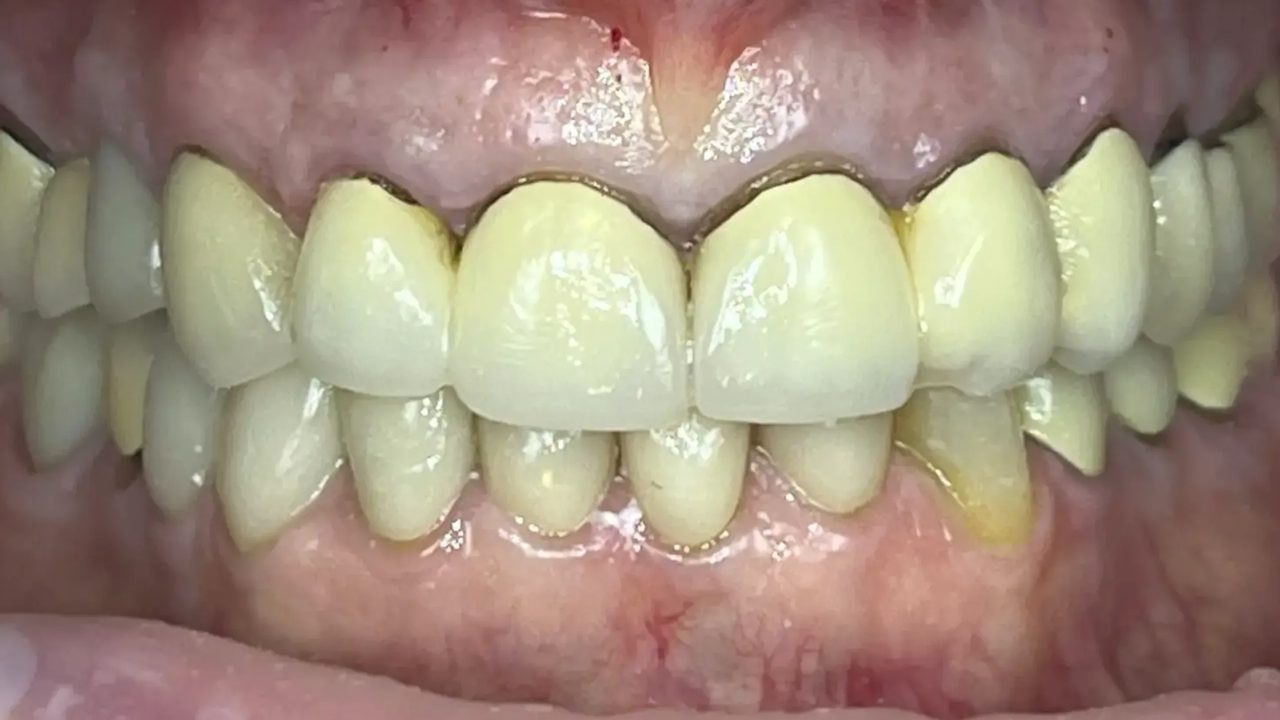 Smile case 15 before treatment
