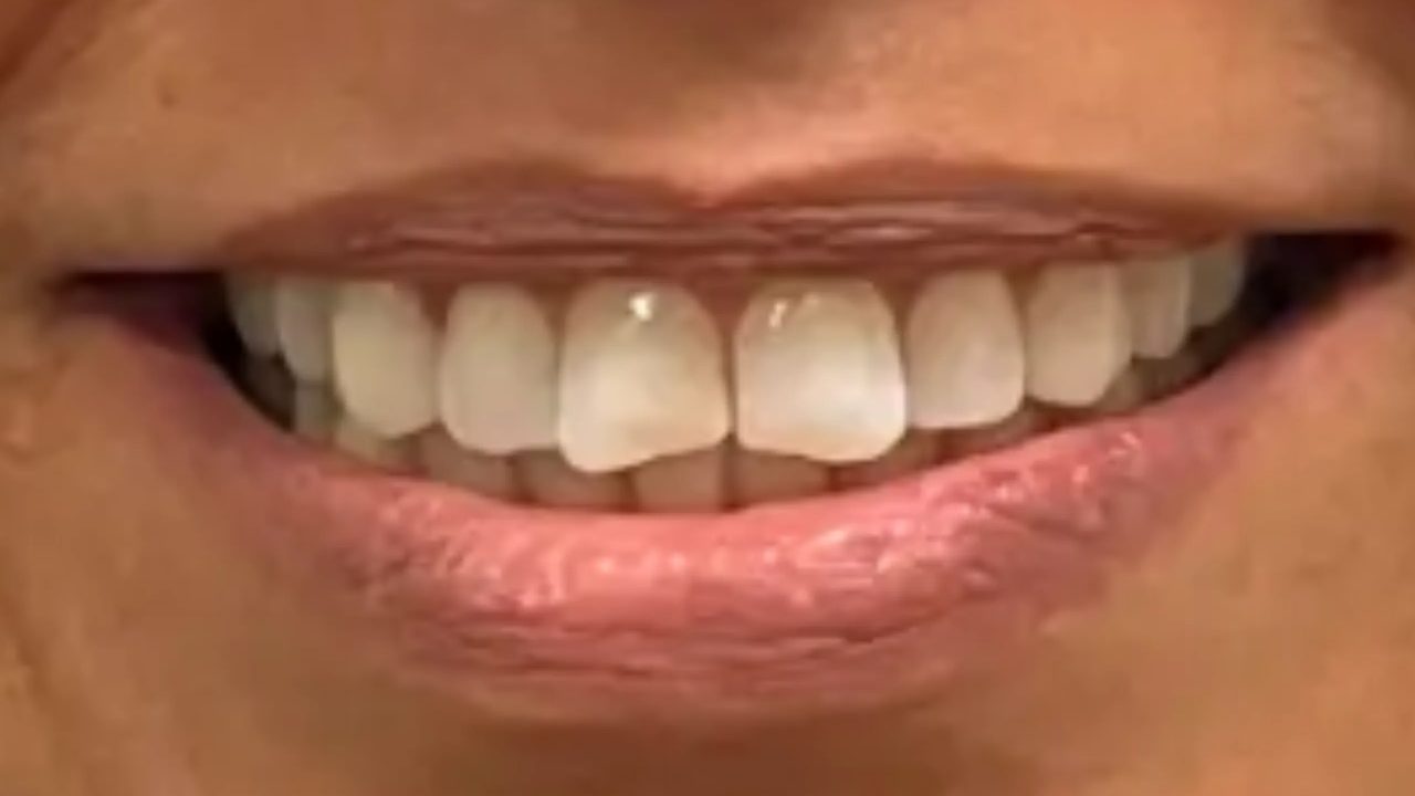 Smile case 16 after treatment at Rovel Dental